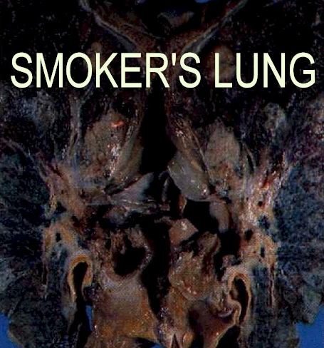  smoking_lungs_black.